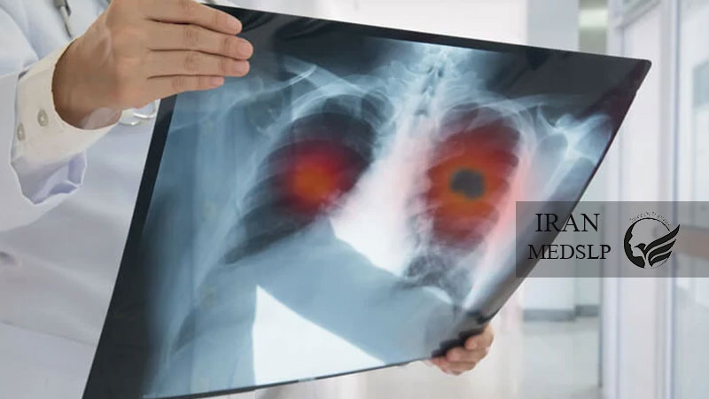 aspiration-pneumonia